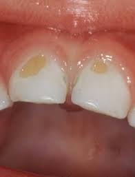 Jan 04, 2018 · treatment for a cavity on the front of a tooth can include: Kid S Dentistry Corner What Do Cavities Look Like Dr Kyle Hornby