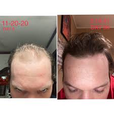 It's been around for nearly three decades and helped literally millions of men to stop losing their hair, and even regrow hair, leading to higher qualities of life. 3 Month Results W Finasteride Minoxidil Malehairadvice