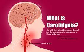 Although its pathophysiology and treatment closely resemble that of its sister condition, carotid artery dissection (cad), the clinical presentation, etiology, and epidemiological profile of vads. What Is Carotidynia How Is It Treated Causes Symptoms Diagnosis Of Carotidynia
