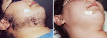 This is one of the top reasons women have hormonal fluctuations and higher testosterone—women with pcos have more testosterone, which results in facial hair growth, says welsh. Facial Hair On Women