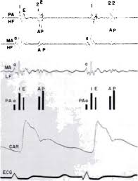 What every physician needs to know. The Clinical Recognition Of Silent Mitral Stenosis Diseases Of The Chest