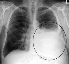 How do we know a patient has a pleural effusion? Nursing Diagnosis And Nursing Interventions For Pleural Effusion Nursing Diagnosis Nursing Interventions