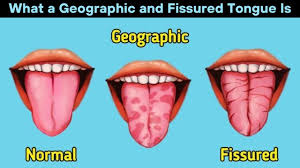 Image result for Fissured tongue