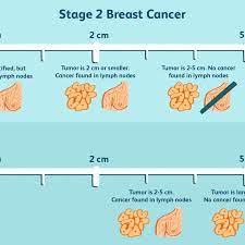 He told me that it is most likely benign, but that he wants to do a needle biopsy on it sometime in the next 2 weeks. Stage 2 Breast Cancer Diagnosis Treatment Survival