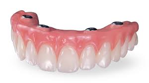 The most frequently asked question. Screw Retained Dentures Glidewell Denture Implant Lab