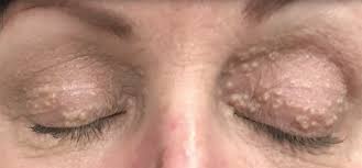 A milium (the plural form is milia) is a tiny white cyst. Video Dr Pimple Popper Extracts Milia On Woman S Eyelids