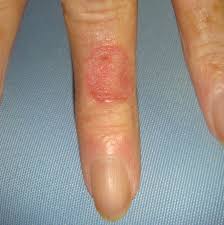 Skin Cancer Spartanburg Hand Surgery