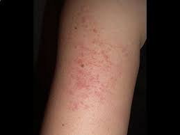 Pin On Keratosis Pilaris Treatment