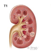 Most lung cancers don't cause symptoms until the disease has advanced, in part because the lungs have few nerve endings. Kidney Cancer In Children Symptoms Diagnosis Treatment Urology Care Foundation