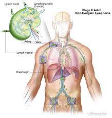 Adult Non Hodgkin Lymphoma Treatment Pdq Patients Siteman Cancer Center