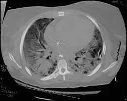 It can occur in many situations and in persons with or without a lung disease. Acute Respiratory Distress Syndrome American Family Physician