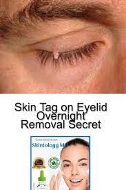 Skin Tag On Eyelid Overnight Removal Secret Skin Tag On Eyelid Skin Tag Skin Tag Removal