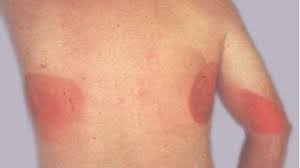 The dermopathy of graves' disease is a rare, painless, reddish lumpy skin rash that of graves' disease is an autoimmune process. Discolored Skin Patches Pictures Causes And Treatments