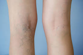 When is varicose vein removal deemed a cosmetic treatment? 4 Facts About Varicose Vein Removal All Patients Should Know