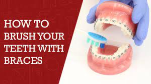 Brushing teeth with braces isn't too different than brushing without braces. How To Brush Teeth With Braces Orthodontics Tips Braces Teeth Youtube