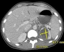 Renal Abscess Caused By Klebsiella Pneumoniae Patient Care Online