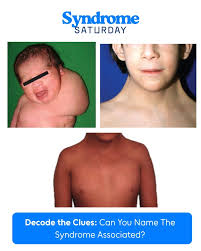 Image result for Webbed Neck