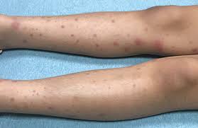 However, the condition is manageable. Rash Triggers Joint Pain In An 8 Year Old Girl Contemporary Pediatrics