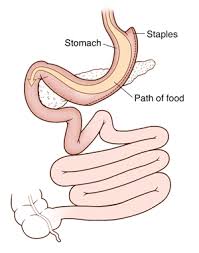 How long do staples stay in place? Gastric Restrictive Surgery Johns Hopkins Medicine