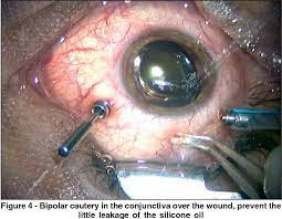 Our physicians and surgeons are the principal faculty of the retina service at wills eye hospital, the nation's first eye hospital which perennially ranks as one of the top eye hospitals in the nation. Pdf Retinal Detachment Surgery With Silicone Oil Injection In Transconjunctival Sutureless 23 Gauge Vitrectomy Semantic Scholar