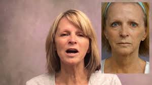 Dr. Lin's J-Plasma SmoothLyft Procedure: Before