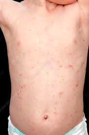 Image result for Urticaria pigmentosa children