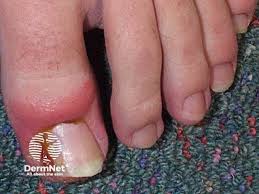 Image result for Paronychia feet