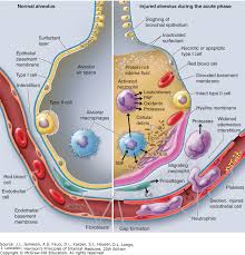 Acute Respiratory Distress Syndrome Harrisons Principles