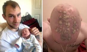 This is also perfectly normal, and will grow back (nhs 2017). Could Hair Wax Cause Baldness Man Claims Product Made Hair Fall Out Express Co Uk