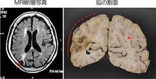 このアカウントには、性的興奮を催すリンクや破廉恥な画像を多数含みます。 もし嫌悪感を感じたらミュートないしはブロック下さい。 #uncensored #無修正 #pornstar #av女優. èªçŸ¥ç—‡ã®ç—‡å€™å­¦ å¾¡æ‰€ãƒ¶è°·ãƒ›ãƒ¼ãƒ ã‚¯ãƒªãƒ‹ãƒƒã‚¯