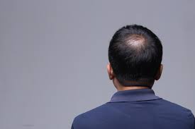 Best hairstyles for men with receding hairline. Getting To The Root Of Hair Loss In Asian Men Dr Tyng Tan