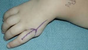 Poland syndrome encompasses a range of chest wall anomalies with possible ipsilateral upper extremity involvement. Children With Congenital Hand Anomalies Malformations Healthychildren Org