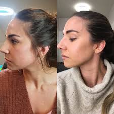 Learn how treatments work, find answers to common questions after the botulinum toxin tmj treatment muscle tenderness will start to disappear almost immediately. My Experience Receiving Botox For Tmj Lauryncakes