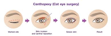 Most cats have beautiful eyes. Blepharoplasty Eyelid Surgery In Bangkok Thailand Kamol Cosmetic Hospital