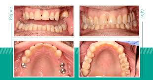 Considering dental implant surgery to replace missing or damaged teeth, but concerned about how bad it will hurt or the pain afterward? Dental Implants Before And After Real Patient Results In Ballard Wa