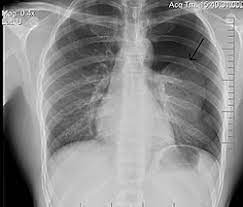 زي لو متوقع pneumothorax أو fb inhalation بس آخد بالي من الـartifact الوارد معاها ، إنها بتبين لي القلب حجمه اكبر هي كمان ، وان بيظهر معاها basal opacities. Ø§Ø³ØªØ±ÙˆØ§Ø­ Ø§Ù„ØµØ¯Ø± ÙˆÙŠÙƒÙŠØ¨ÙŠØ¯ÙŠØ§
