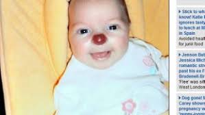 Menina nasce com nariz vermelho e passa por cirurgia de três horas para  corrigir o problema