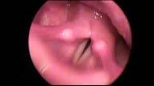 Do you know if and when you should use it? Bilateral Vocal Cords Folds Paralysis Diagnosed By Prof Dr Mohamed El Sawy Youtube