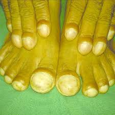 Image result for Clubbing nails feet