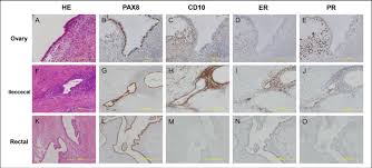In addition to these causes, other factors and conditions seem. Pax8 Cd10 Er And Pr Expression In Ovarian Endometrioma And Download Scientific Diagram