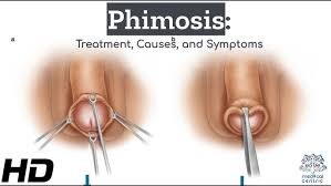 Image result for Phimosis