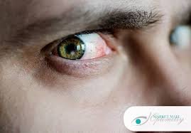 Image result for Eye Discharge