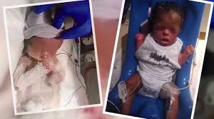 Home » current events » 10 babies born in 1 birth? Baby Born Without Skin Can Be Kissed Held By Family After First Of Its Kind Transplant