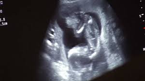 Mentionez ca bebe se hraneste strict cu lapte de mama, de la san, din 2 in 2 ore. La 17 Saptamani De Sarcina Youtube