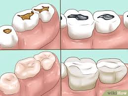 Maybe you would like to learn more about one of these? 3 Ways To Know If Your Dental Fillings Need Replacing Wikihow