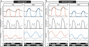 Image result for Delayed Transition from Fetal Circulation