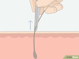 Use a sharp razor and always shave in the direction of hair growth. How To Get Rid Of Ingrown Pubic Hair With Pictures Wikihow