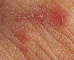 Image result for scabies bite