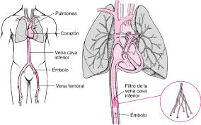 Síndrome resultante de la migración de trombos venosos hacia la circulación pulmonar que ocasiona alteraciones hemodinámicas y ventilatorias por aumento de las rvp e hap que ocasiona disfunción. Embolia Pulmonar Ep Trastornos Del Pulmon Y Las Vias Respiratorias Manuale Merck Version Para El Publico General
