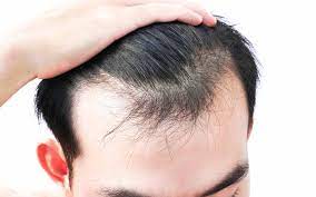 Hair loss treatment is most effective when started at the first sign of hair loss, so if you do notice a change contact your dermatologist. Genetic Hair Loss Treatment Southern Dermatology